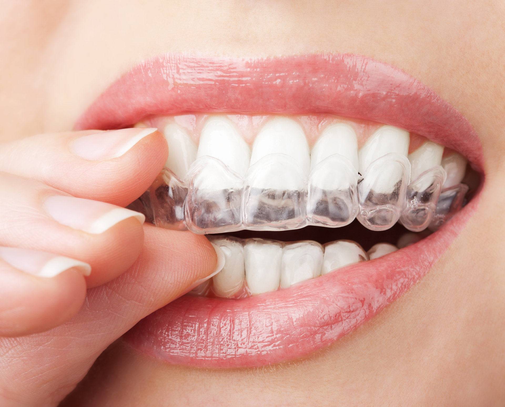 Sbiancamento dentale: come funziona e cosa si fa