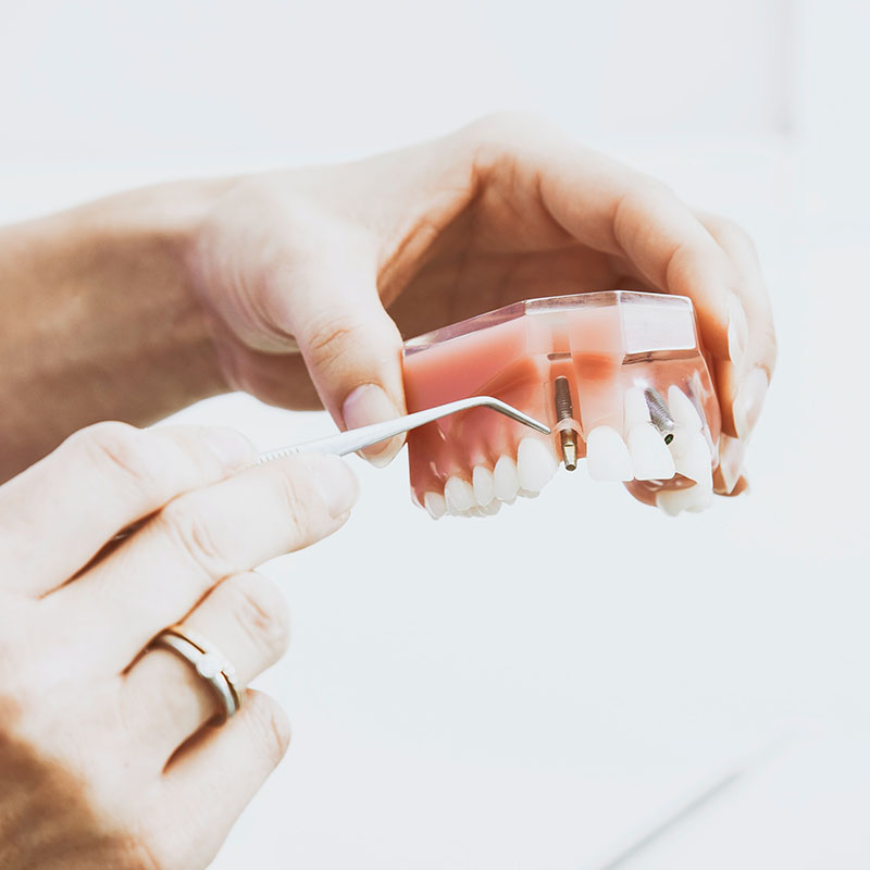 Studio Dentistico Sepe - Chirurgia Orale e Implantare
